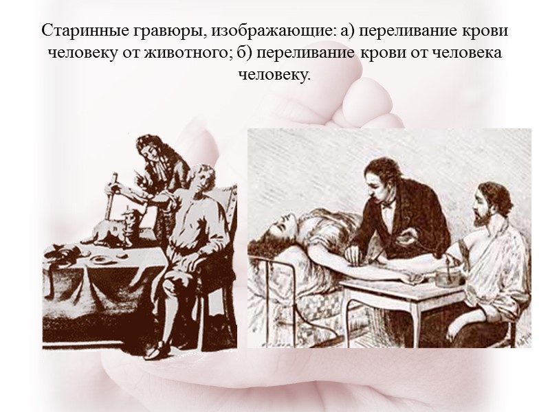 Старинные гравюры, изображающие: а) переливание крови человеку от животного; б) переливание крови от человека